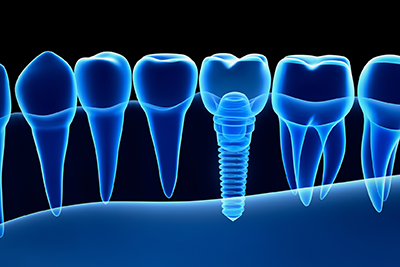 dental implant 3D xray