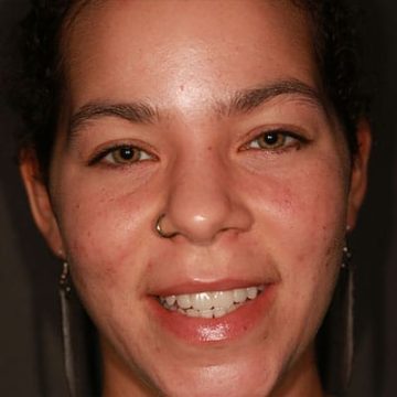 full face view of patient after cosmetic dental procedure